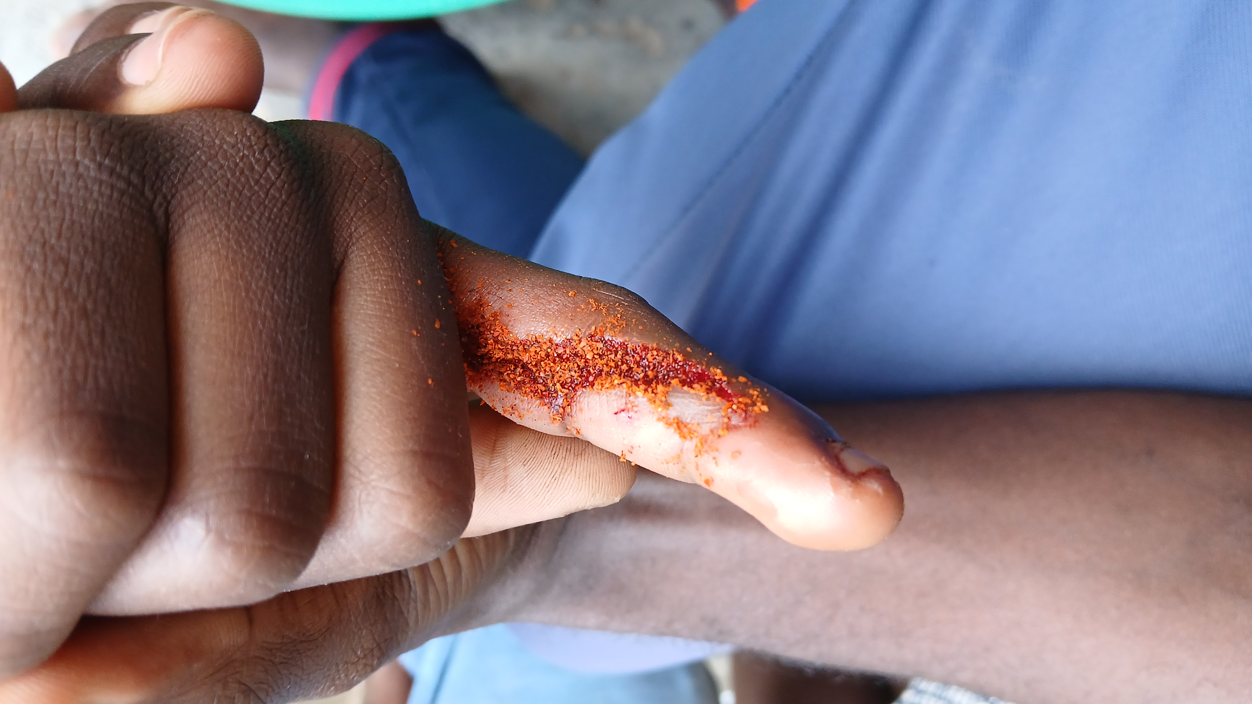 Treating a boy who got an accident